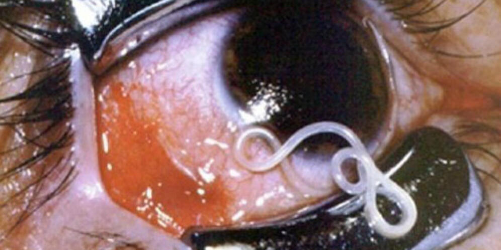 CACING 30 CM HIDUP DI MATA, KARENA SOFTLENS ATAU MASKARA