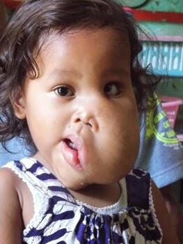 Septiana Dewi, Gadis Kecil Penderita Hygroma colli