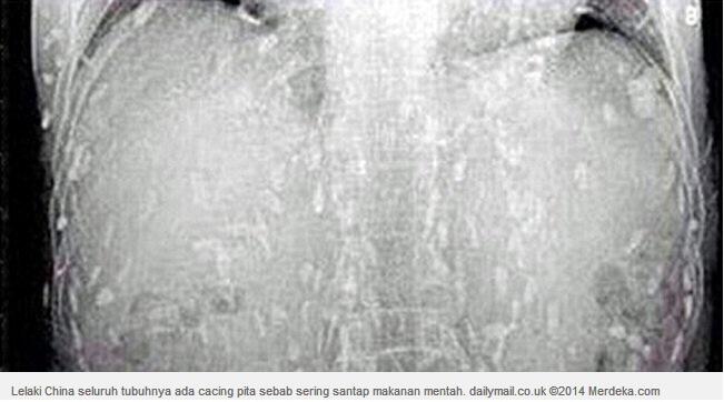 Sering santap ikan mentah, tubuh lelaki China penuh cacing pita