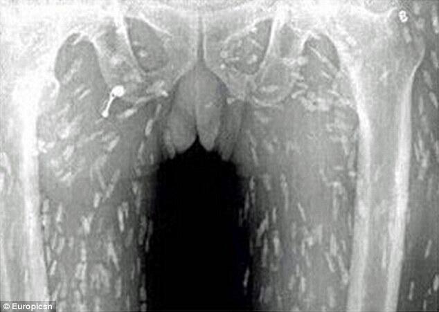 Sushi lover's entire body left riddled with WORMS after eating contaminated sashimi