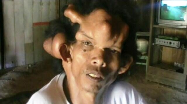 Penyakit Aneh Setelah Jatuh Dari Pohon Kelapa