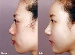 Tips Dan Cara Membuat Hidung Mancung Tanpa Operasi