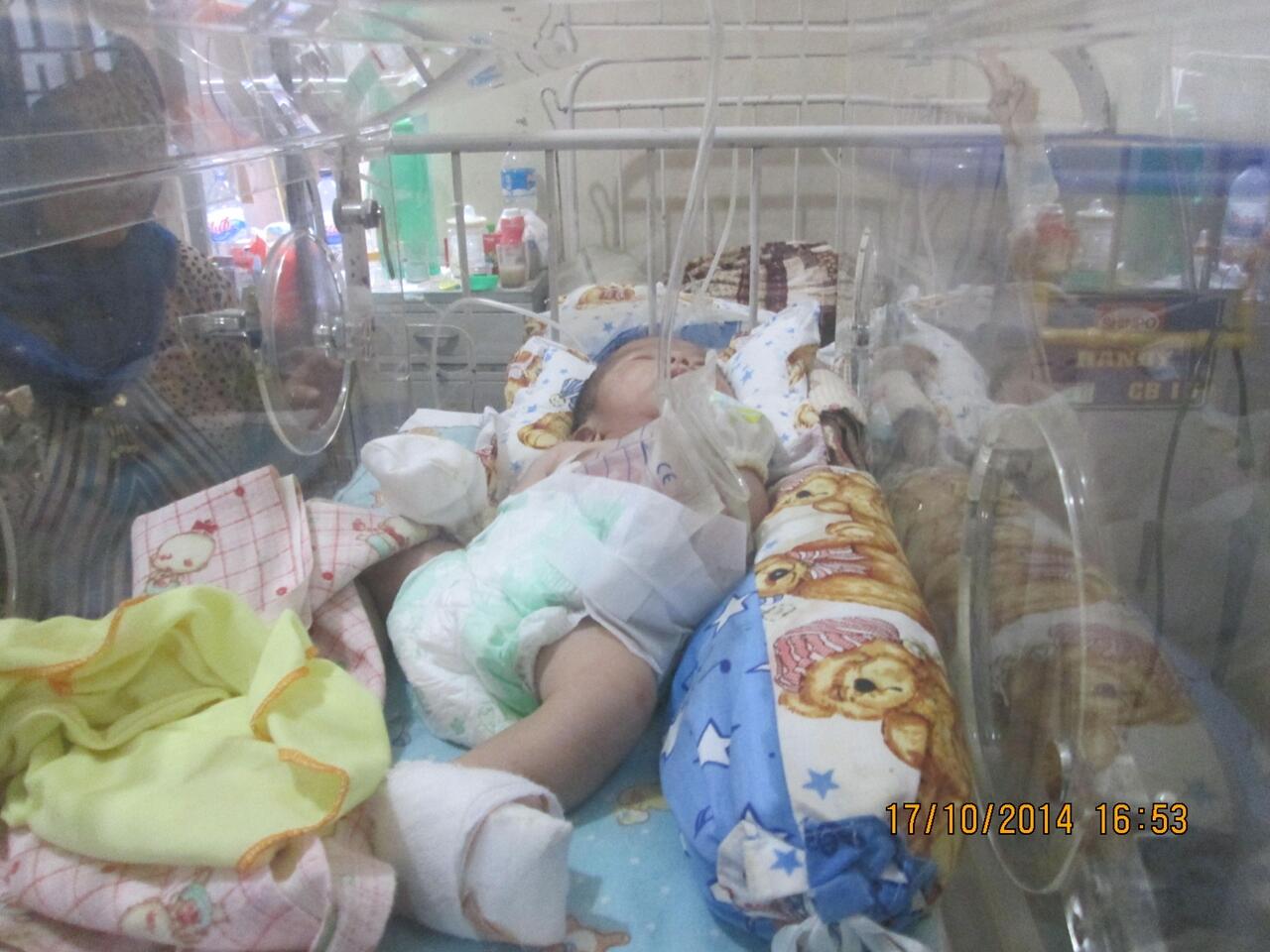 ( Penyakit Gastroschisis ) Bayi Petani ini butuh bantuan 