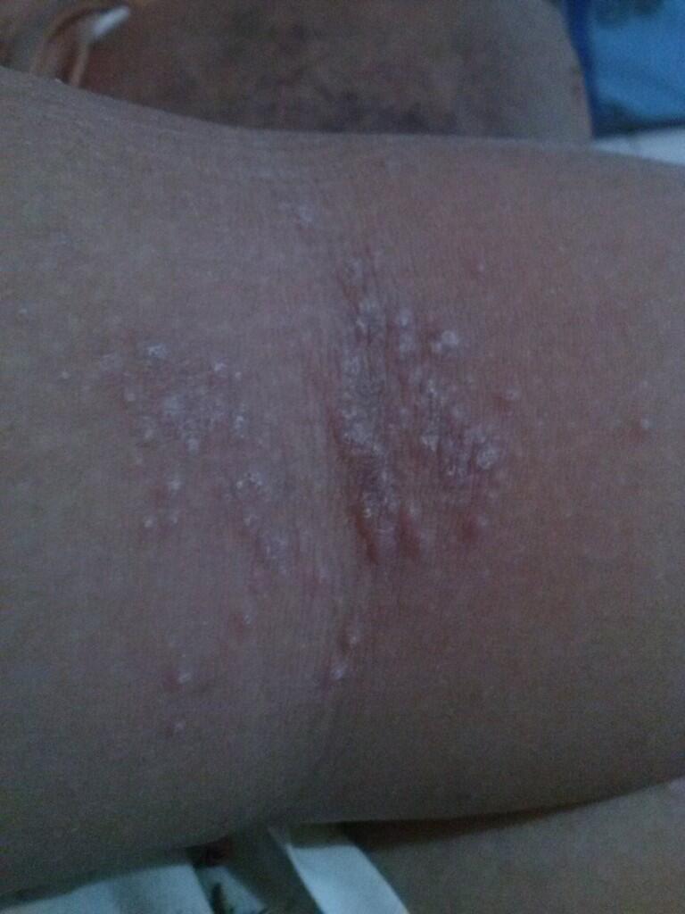 &#91;HELP!&#93; Tolong gan...ane kena penyakit kulit !!!!