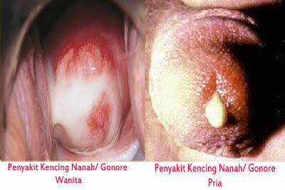 Obat Herbal Sipilis / Raja Singa, Kencing Nanah / Gonore dan Infeksi Saluran Kencing