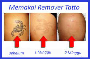 Cara Menghapus Tatto - Penghilang tato permanen - Remover Tatto