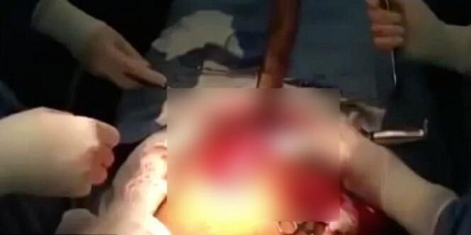 Mengerikan, Belut Sepanjang 125 Cm Hidup di Perut Pria Ini | Cekidot