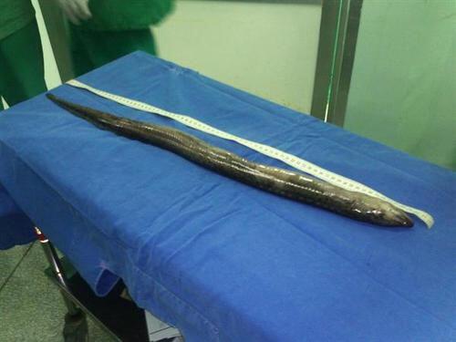 Mengerikan, Belut Sepanjang 125 Cm Hidup di Perut Pria Ini | Cekidot