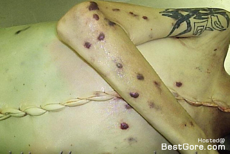 AIDS + Heroin = .....