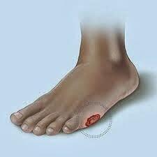 Waspadai 8 Gejala Diabetes Melitus