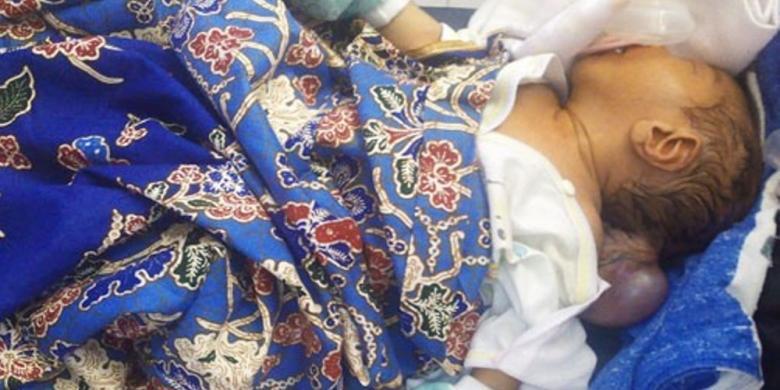 &#91;THEY NEED HELP&#93; Tak Ada Biaya, Bayi Tanpa Batok Kepala Belakang Dibiarkan Menderita