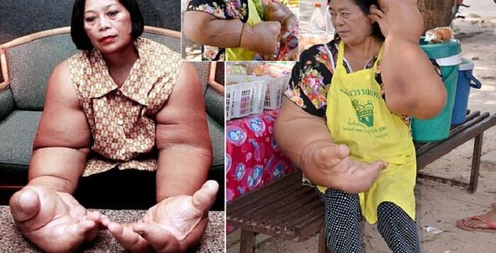 Duangjay Samaksamam, Wanita Pemilik Tangan Terbesar di Dunia