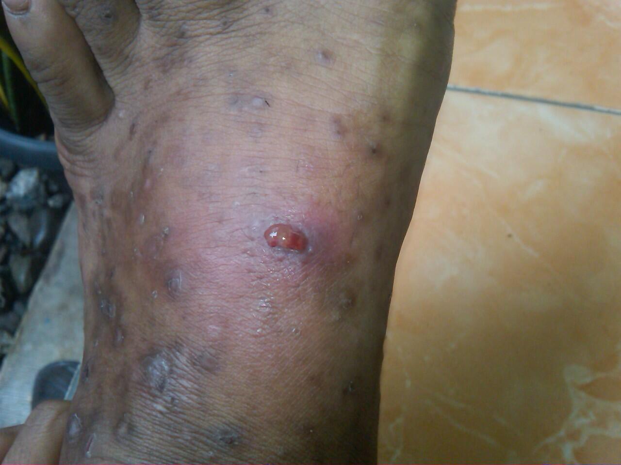 &#91;help&#93; kaki kiri ane bengkak :(