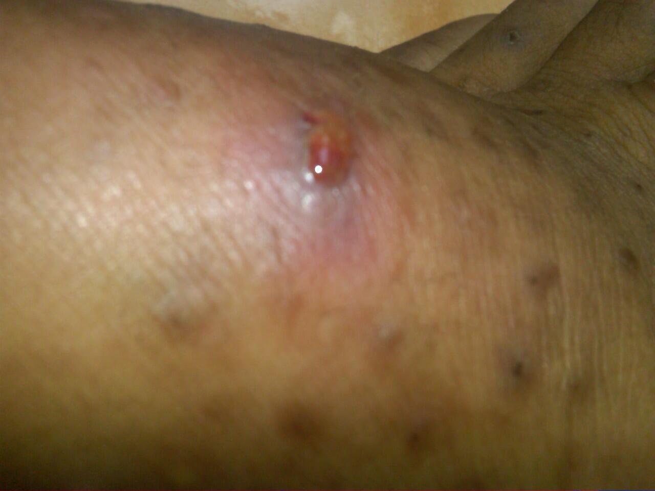 &#91;help&#93; kaki kiri ane bengkak :(