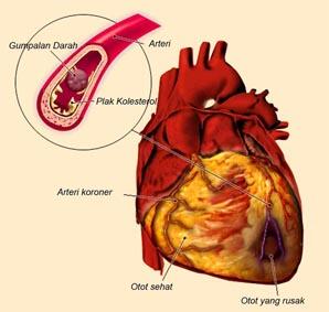 Yuk cek!!Kebiasaan Sederhana yang menyebabkan sakit Jantung Koroner