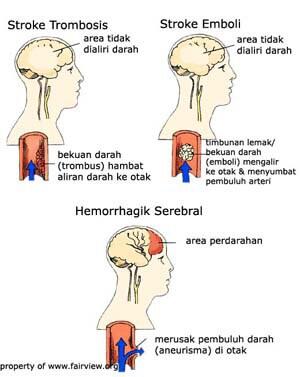 Gan, Yuk Sayang Keluarga Dengan Mengenali Gejala Stroke Sejak Dini!