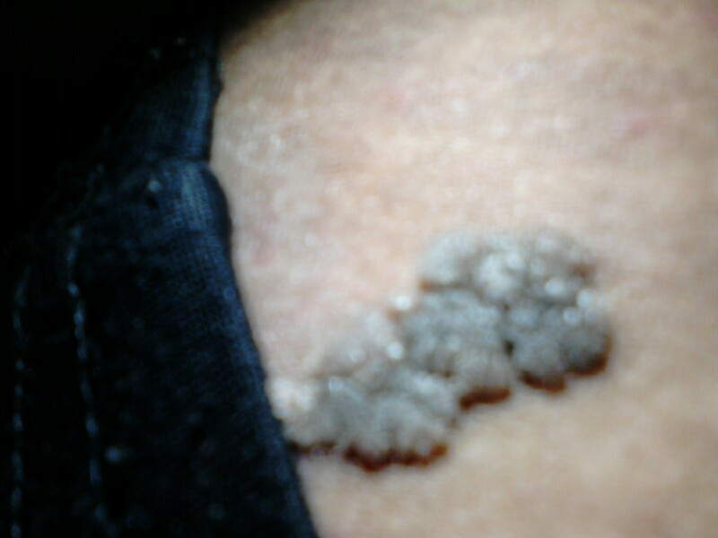 &#91;ASK&#93;INI MELANOMA ATAU TAHI LALAT?