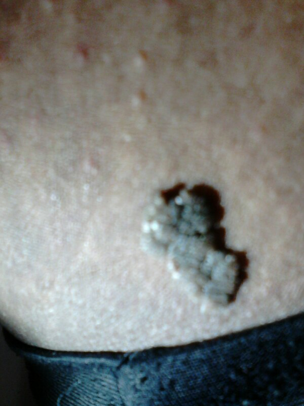 &#91;ASK&#93;INI MELANOMA ATAU TAHI LALAT?