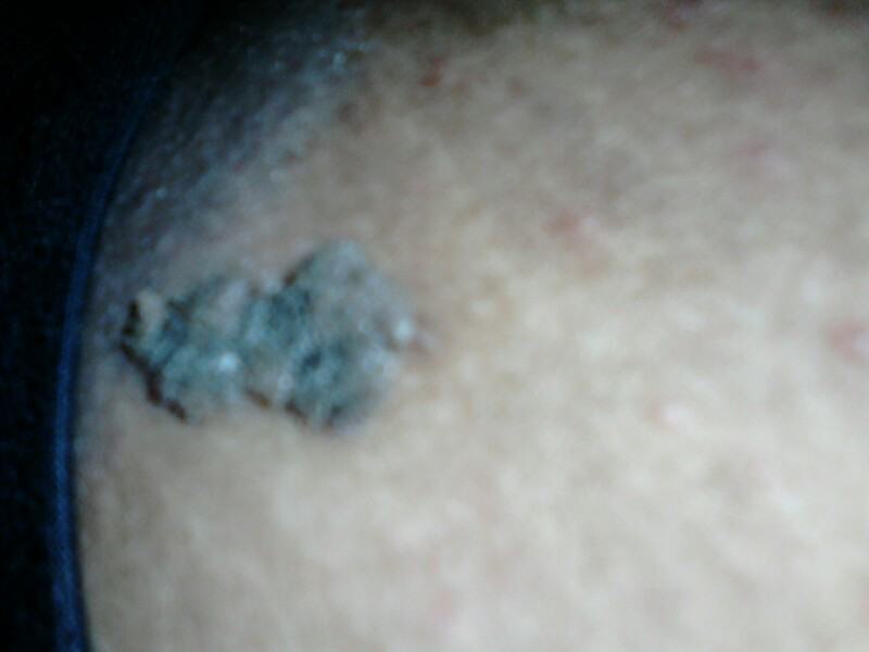 &#91;ASK&#93;INI MELANOMA ATAU TAHI LALAT?