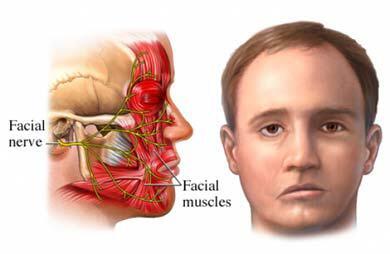 Fakta-fakta Bell's Palsy, Penyakit yang Bikin Wajah Rano Karno Kaku Separuh