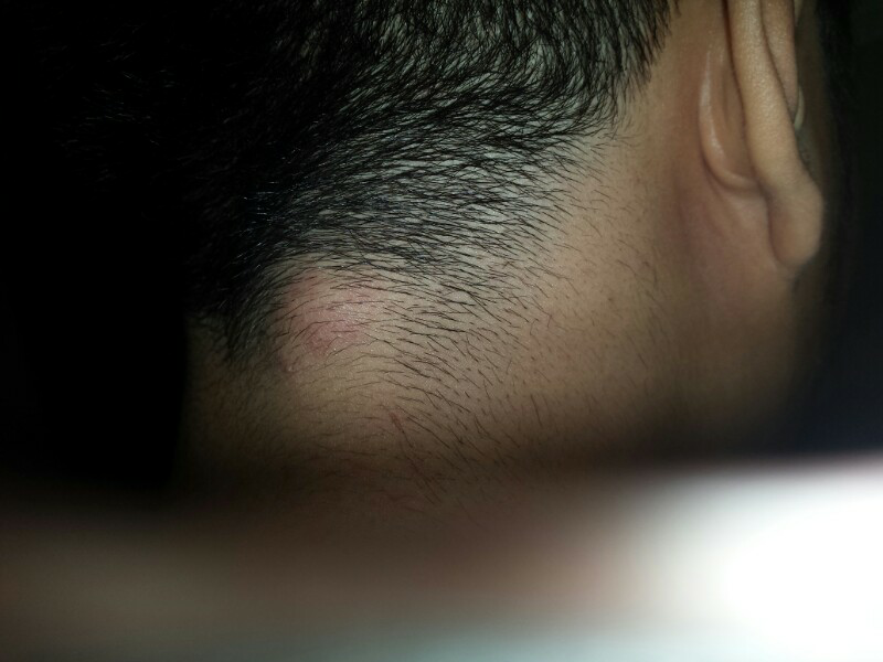 (ask) gan ini penyakit apa ya uda 2 tahun stgh katannya lipoma