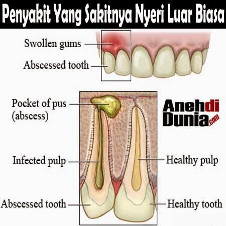 Penyakit Yang Sakitnya Nyeri Luar Biasa