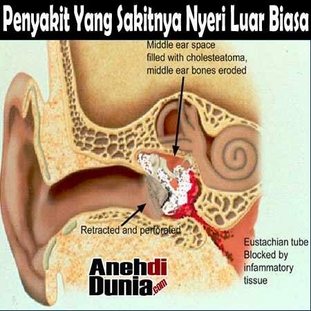 Penyakit Yang Sakitnya Nyeri Luar Biasa