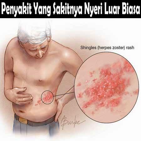 Penyakit Yang Sakitnya Nyeri Luar Biasa