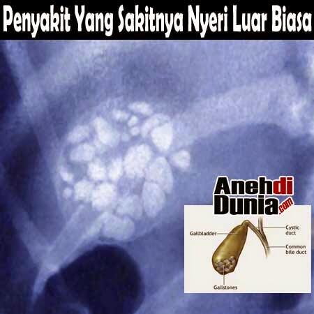 Penyakit Yang Sakitnya Nyeri Luar Biasa
