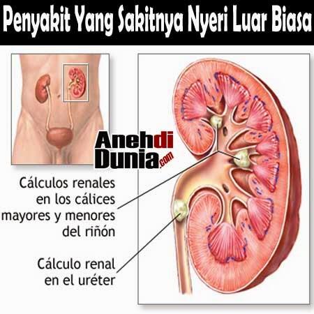 Penyakit Yang Sakitnya Nyeri Luar Biasa