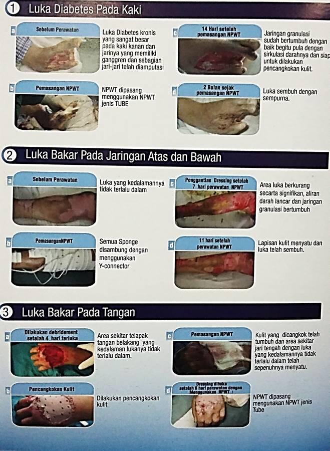 Info perawatan LUKA yang SUSAH SEMBUH menggunakan NEGATIVE PRESSURE WOUND THERAPY