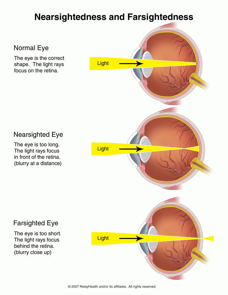 Fact about Astigmatism - Kata siapa sih, mata silinder GAK BISA LIHAT GARIS LURUS??