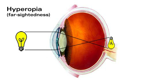 &#91;share&#93; plus minus Exotropia (pengalaman TS)