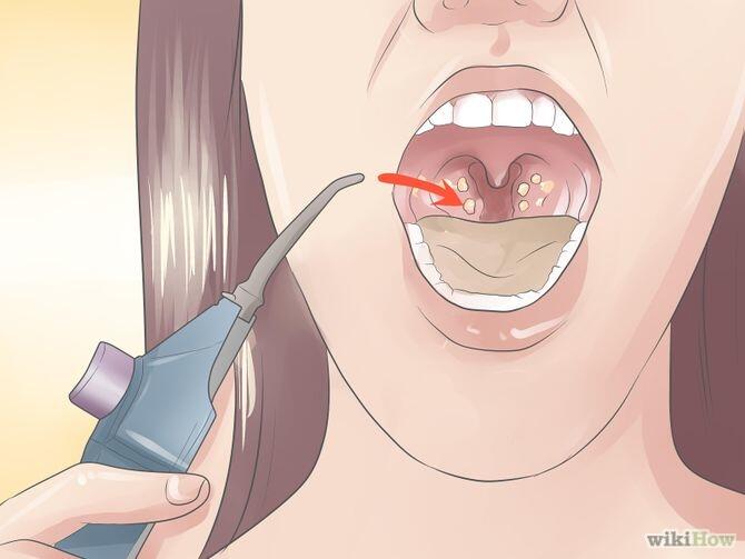 Apa itu Tonsil  Stone nih cara menghilangkannya KASKUS