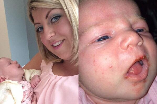 Bayi terinfeksi Herpes - Jangan Biarkan Bayi Anda Digendong dan Dicium Orang2