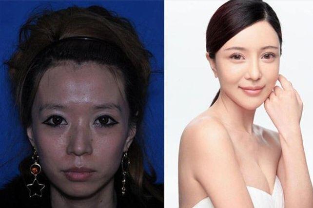 Whoa! Foto-Foto Wanita China Jalani Operasi Plastik Bikin Shock