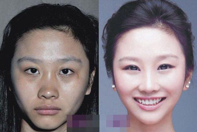 Whoa! Foto-Foto Wanita China Jalani Operasi Plastik Bikin Shock
