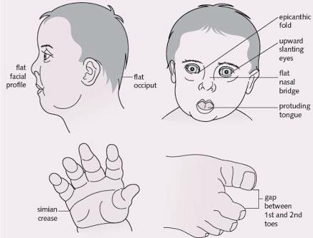 anak sering senyum&amp;ketawa?WASPADA angelman syndrome