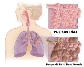 Penyakit Paling Mematikan di Dunia Sepanjang Tahun 2015