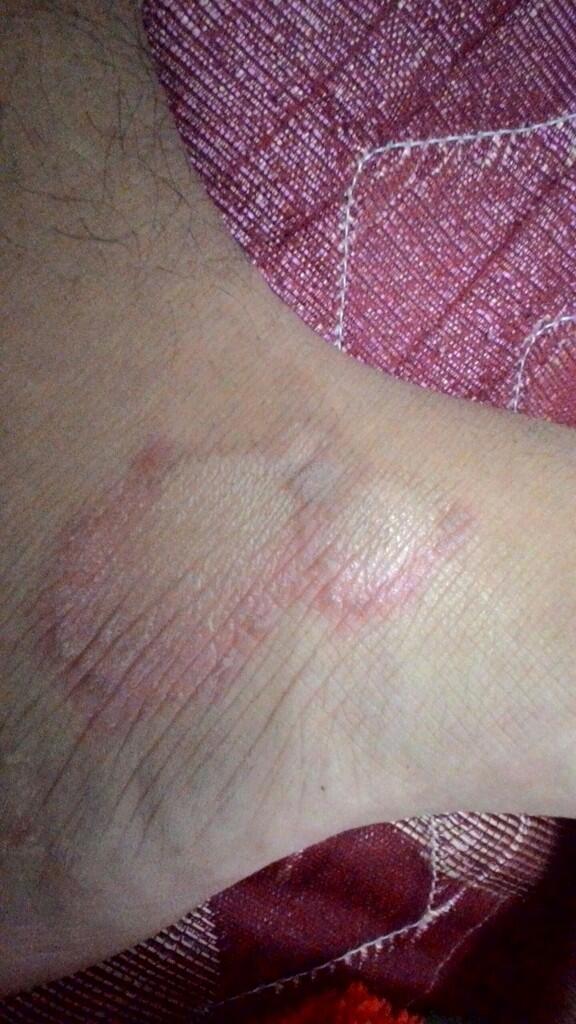 &#91;help&#93;kulit ada bercak merah tidk gatal 