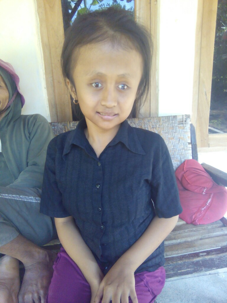 Penggalangan dana dan doa buat dik Putri penderita hydrocephalus (Karesidenan Kediri)