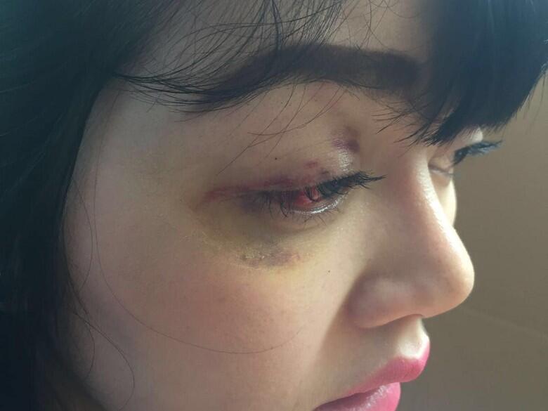 Begini Kondisi Luka Dita yang Polisikan Anggota DPR Masinton