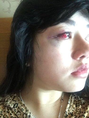 Begini Kondisi Luka Dita yang Polisikan Anggota DPR Masinton