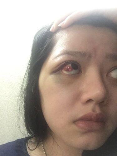 Begini Kondisi Luka Dita yang Polisikan Anggota DPR Masinton