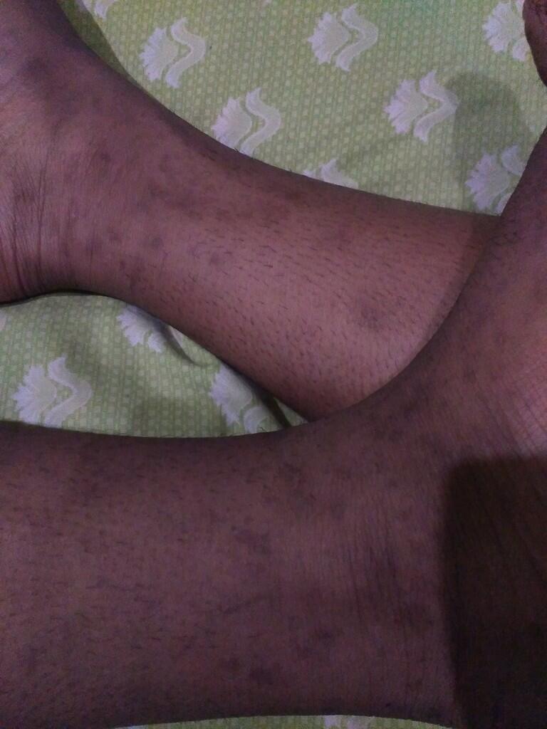 (help) (ask)gimana cara Ngehilangin flek hitam di kaki yang udah bertahun tahun