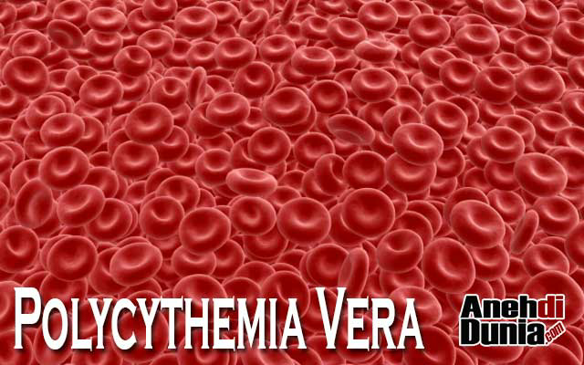 inilah penyakit yang berguna bagi penderita nya.. nah loh