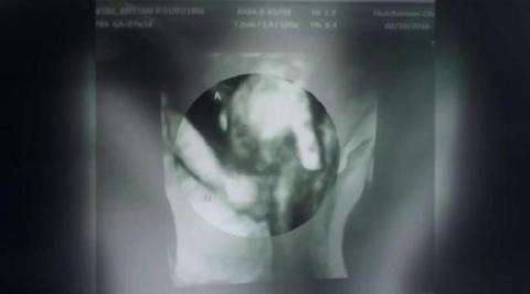 Foto USG Mengharukan, Janin Pegang Tangan Kembaran yang Sekarat