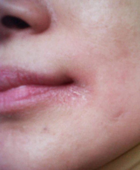 (ask) tanya dong obat angular cheilitis apa?