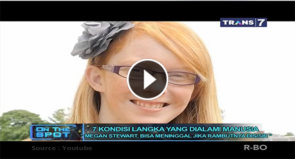 Wanita Ini Akan Meninggal Kalau Rambutnya Disisir