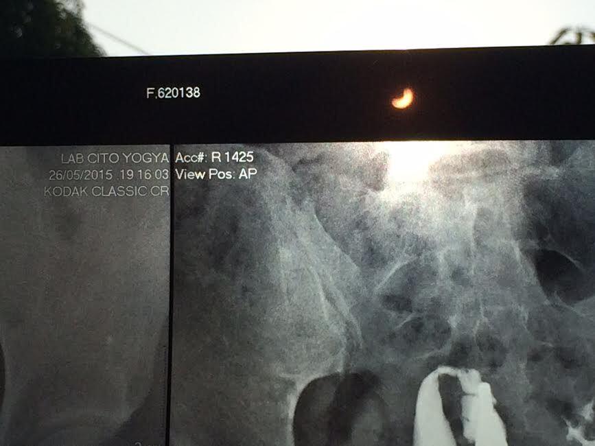 Begini Cara Masyarakat Lihat Gerhana, dengan Slide Film Sampai Hasil Rontgen